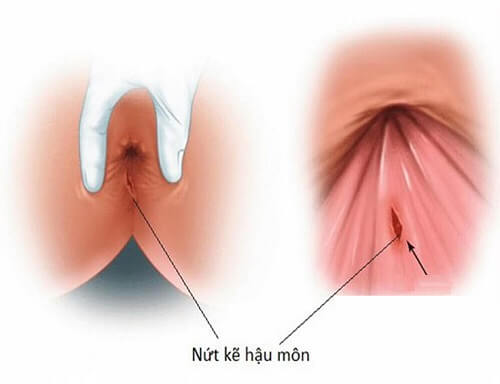 Nứt kẽ hậu môn